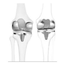NG knee implants